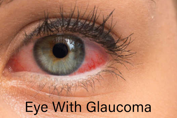 Best Glaucoma Hospital in Greater Kailash
